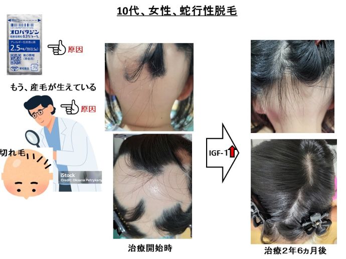 円形脱毛症　病院